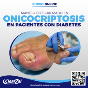 Manejo Especializado Onicocriptosis en Pacientes Diabéticos