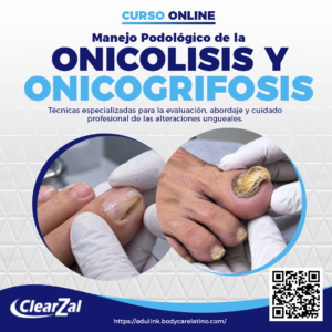 Manejo Podológico de la Onicolisis y Onicogrifosis