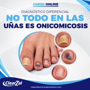 NO TODO EN LAS UÑAS ES ONICOMICOSIS